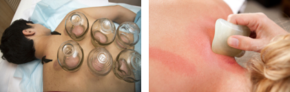 Chinese cupping Gua Sha