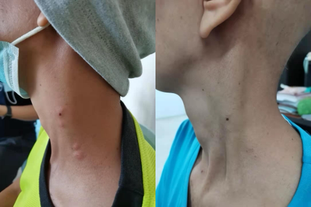 lymph node swelling